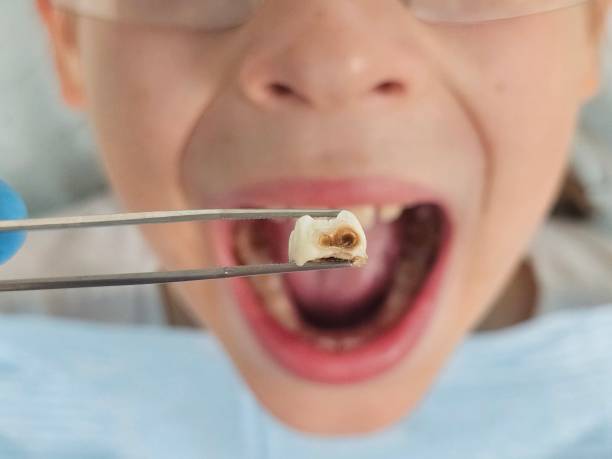 Best Emergency Dentist for Knocked-Out Tooth in West Wendover, NV